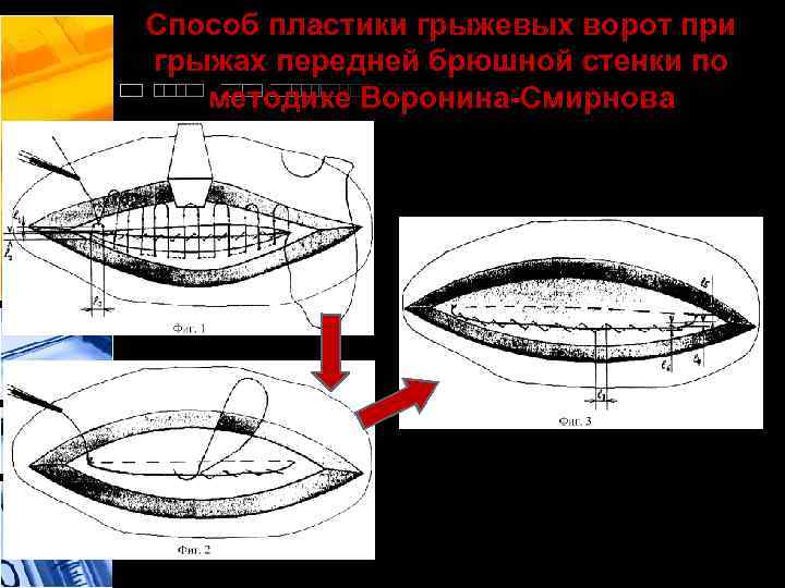 Способ пластики грыжевых ворот при грыжах передней брюшной стенки по методике Воронина-Смирнова 