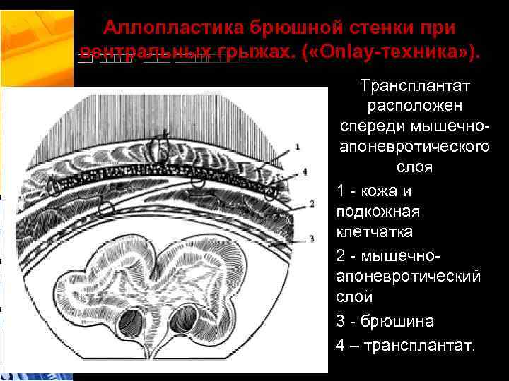 Аллопластика брюшной стенки при вентральных грыжах. ( «Onlay-техника» ). Трансплантат расположен спереди мышечноапоневротического слоя