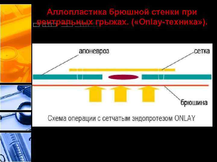 Аллопластика брюшной стенки при вентральных грыжах. ( «Onlay-техника» ). 