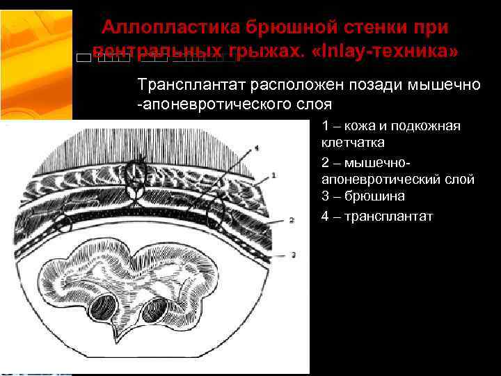 Аллопластика брюшной стенки при вентральных грыжах. «Inlay-техника» Трансплантат расположен позади мышечно -апоневротического слоя 1