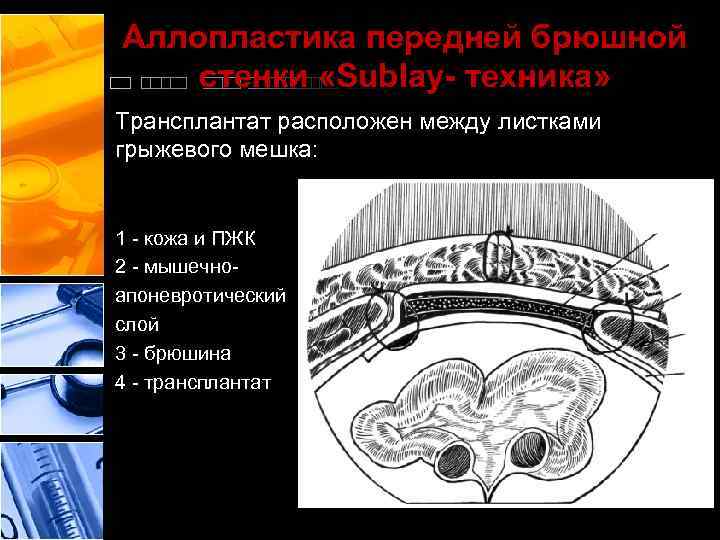 Аллопластика передней брюшной стенки «Sublay- техника» Трансплантат расположен между листками грыжевого мешка: 1 -