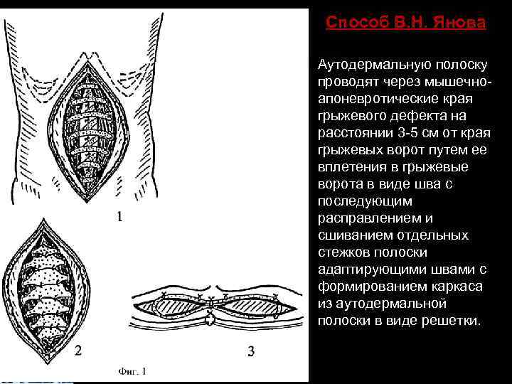 Способ В. Н. Янова Аутодермальную полоску проводят через мышечноапоневротические края грыжевого дефекта на расстоянии
