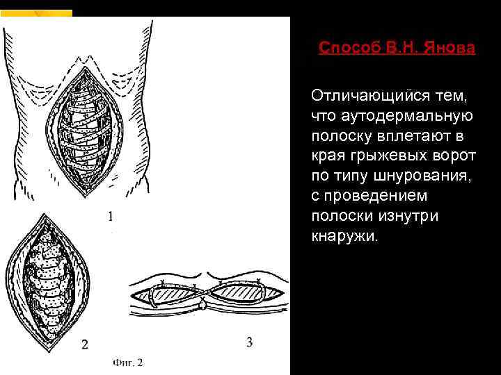 Способ В. Н. Янова Отличающийся тем, что аутодермальную полоску вплетают в края грыжевых ворот