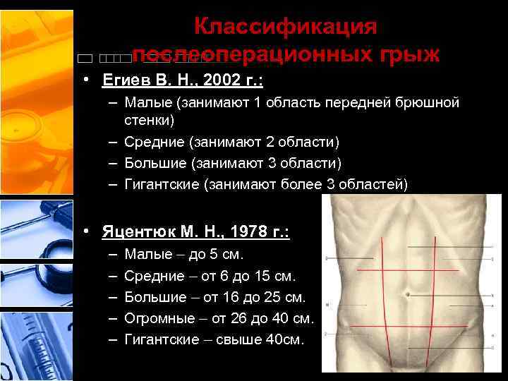 Классификация послеоперационных грыж • Егиев В. Н. , 2002 г. : – Малые (занимают