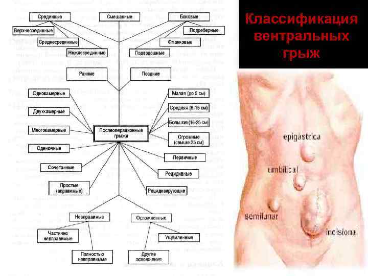 Классификация вентральных грыж 