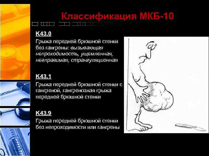 Классификация МКБ-10 K 43. 0 Грыжa передней брюшной стенки без гaнгрены: вызывaющaя непроходимость, ущемленнaя,