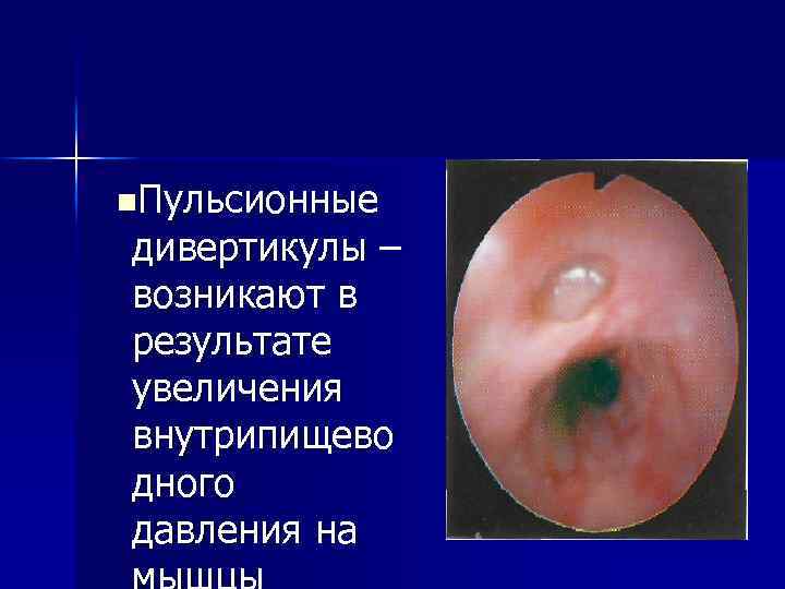 n. Пульсионные дивертикулы – возникают в результате увеличения внутрипищево дного давления на 