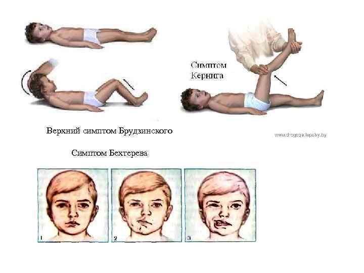 Верхний симптом Брудзинского Симптом Бехтерева 