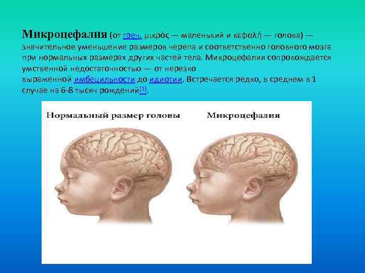 Микроцефалия (от греч. μικρός — маленький и κεφαλή — голова) — значительное уменьшение размеров