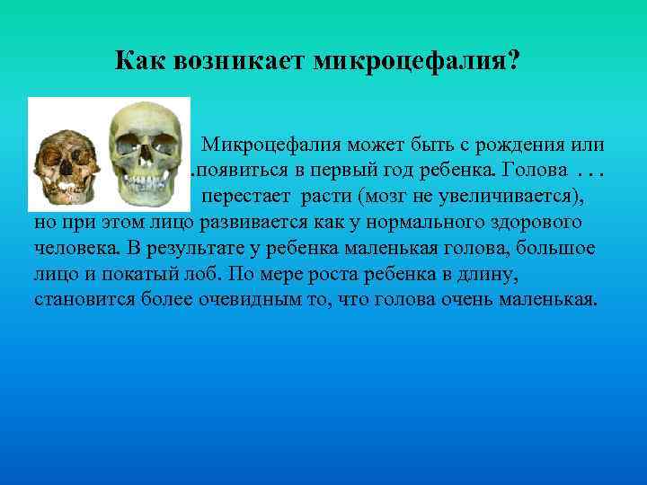 Как возникает микроцефалия? . . Микроцефалия может быть с рождения или . . .