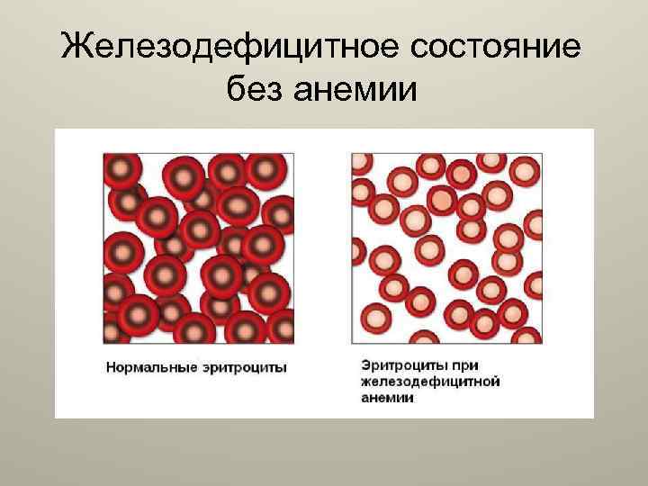 Железодефицитное состояние без анемии 