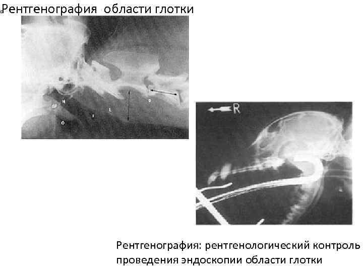Рентгенография области глотки Рентгенография: рентгенологический контроль проведения эндоскопии области глотки 