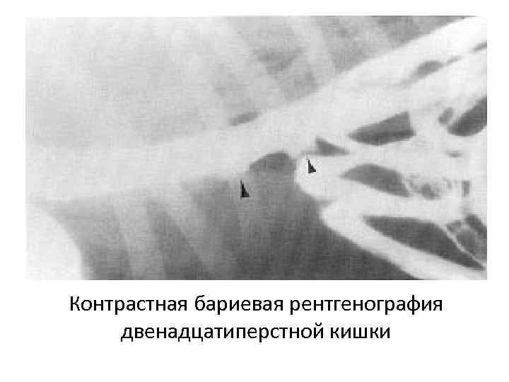 Контрастная бариевая рентгенография двенадцатиперстной кишки 