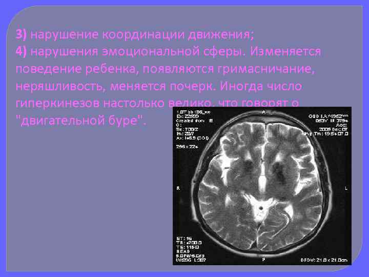 3) нарушение координации движения; 4) нарушения эмоциональной сферы. Изменяется поведение ребенка, появляются гримасничание, неряшливость,