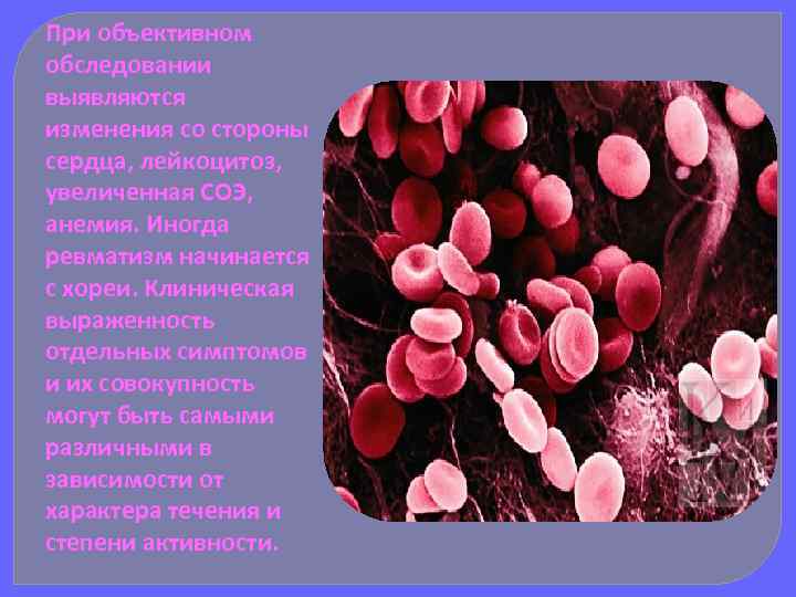 При объективном обследовании выявляются изменения со стороны сердца, лейкоцитоз, увеличенная СОЭ, анемия. Иногда ревматизм