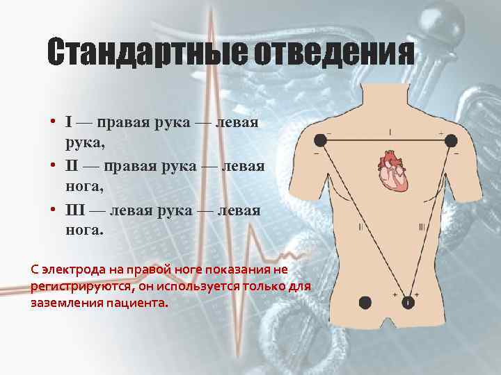 Стандартные отведения • I — правая рука — левая рука, • II — правая