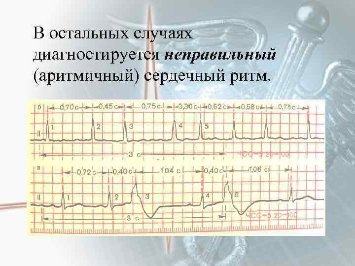 В остальных случаях диагностируется неправильный (аритмичный) сердечный ритм. 