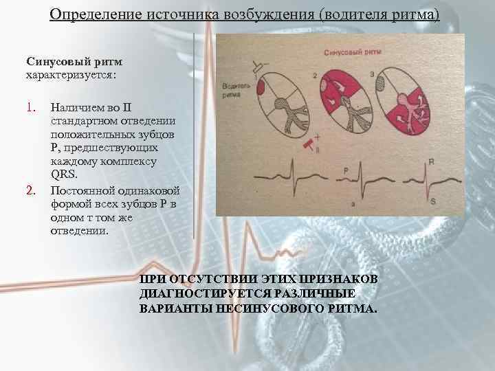 Определение источника возбуждения (водителя ритма) Синусовый ритм характеризуется: 1. 2. Наличием во II стандартном