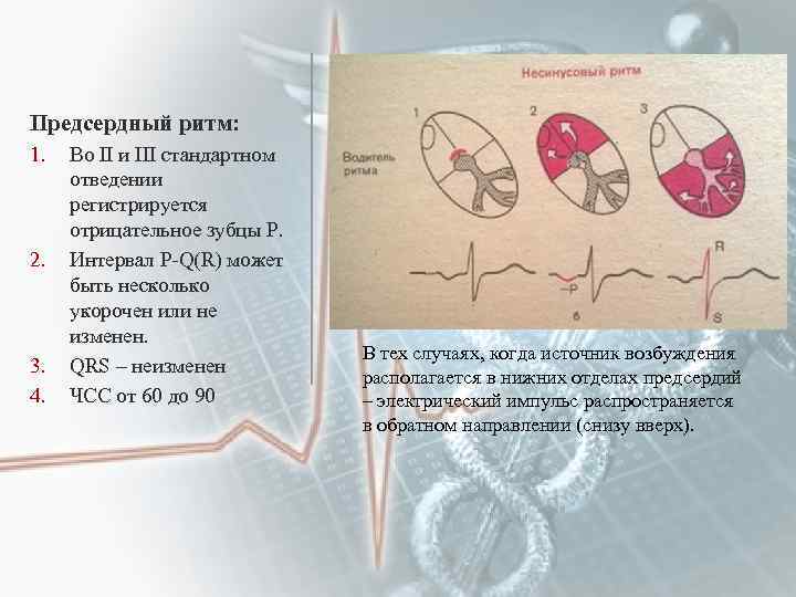 Предсердный ритм: 1. 2. 3. 4. Во II и III стандартном отведении регистрируется отрицательное