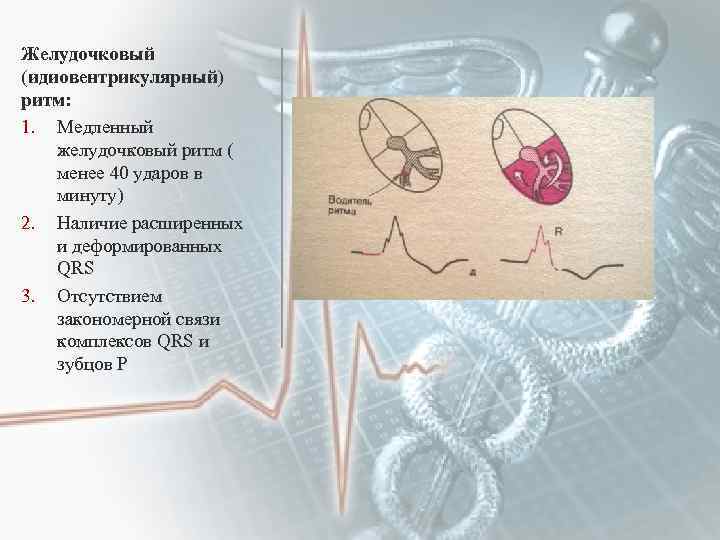 Желудочковый (идиовентрикулярный) ритм: 1. Медленный желудочковый ритм ( менее 40 ударов в минуту) 2.