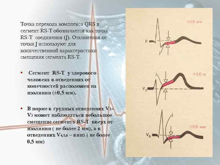 Точка перехода комплекса QRS в сегмент RS-T обозначается как точка RS-T соединения (j). Отклонения