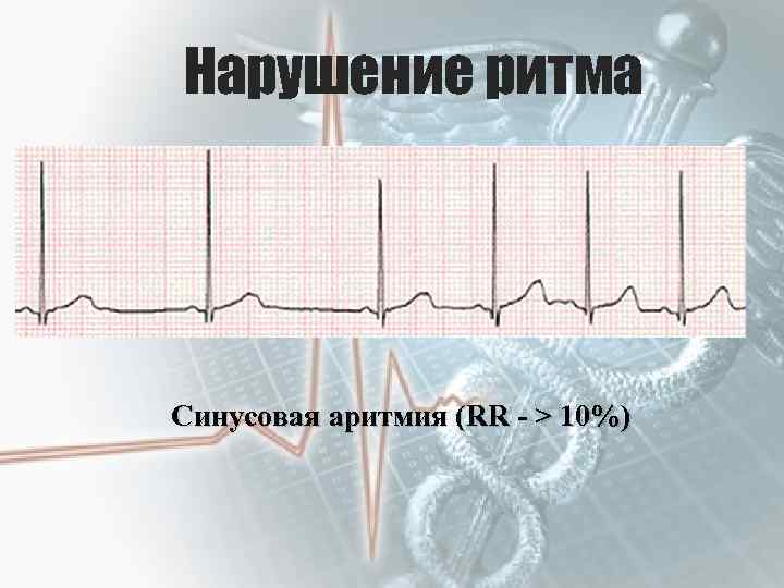 Нарушение ритма Синусовая аритмия (RR - > 10%) 