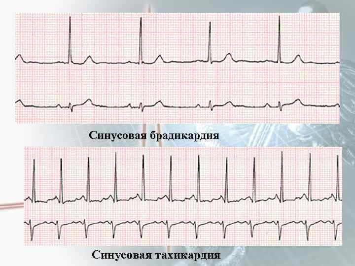 Синусовая брадикардия Синусовая тахикардия 