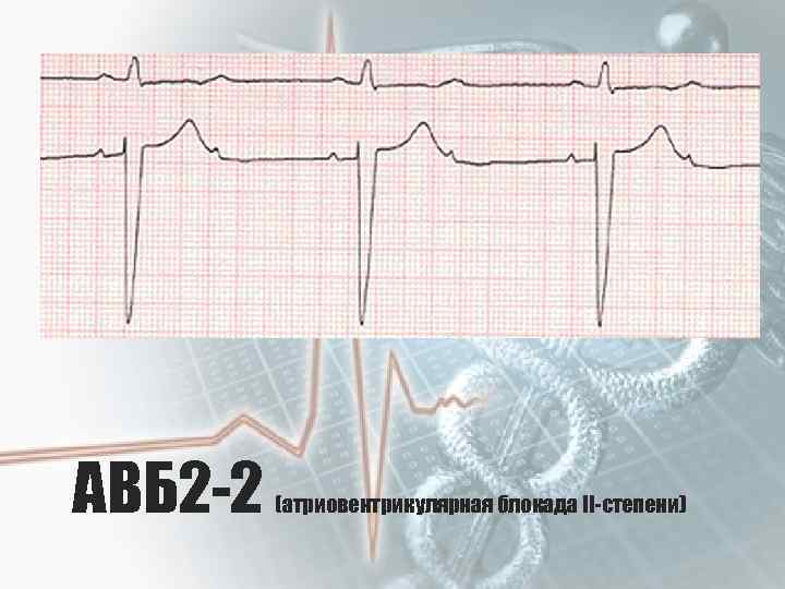 АВБ 2 -2 (атриовентрикулярная блокада II-степени) 
