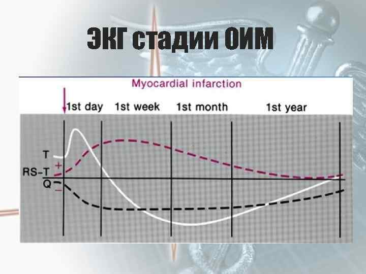 ЭКГ стадии ОИМ 