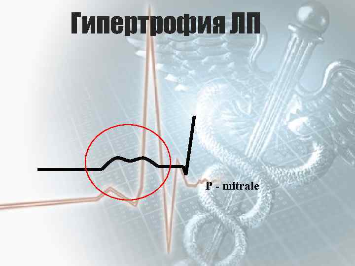 Гипертрофия ЛП Р - mitralе 