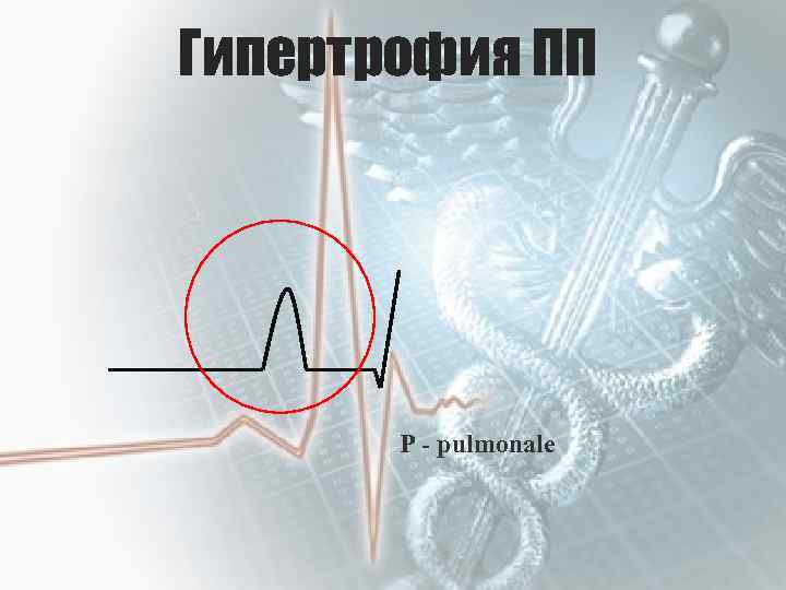 Гипертрофия ПП Р - pulmonale 