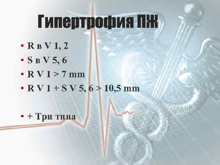 Гипертрофия ПЖ • • R в V 1, 2 S в V 5, 6