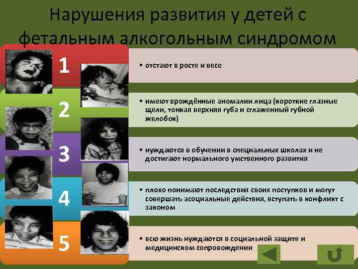 Нарушения развития у детей с фетальным алкогольным синдромом 1 • отстают в росте и