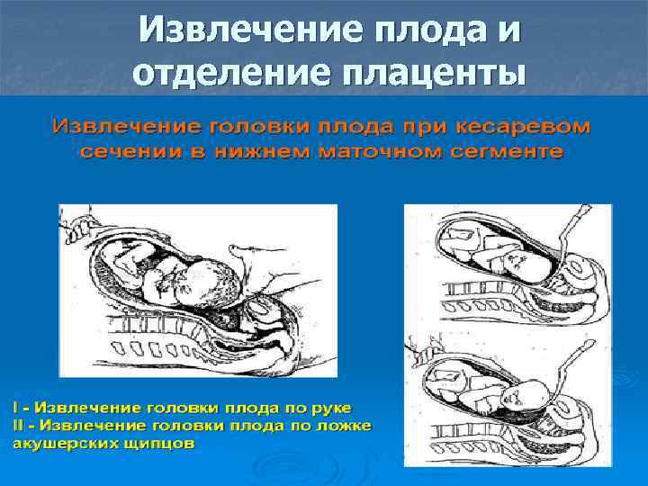 Извлечение плода и отделение плаценты 