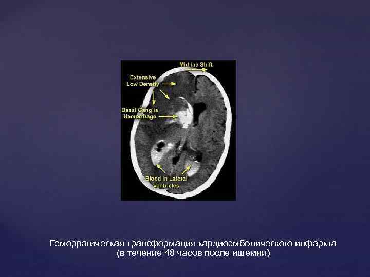 Геморрагическая трансформация кардиоэмболического инфаркта (в течение 48 часов после ишемии) 