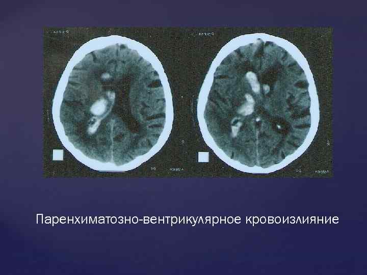 Кровоизлияния головного мозга последствия