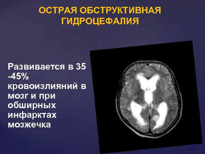 ОСТРАЯ ОБСТРУКТИВНАЯ ГИДРОЦЕФАЛИЯ Развивается в 35 -45% кровоизлияний в мозг и при обширных инфарктах