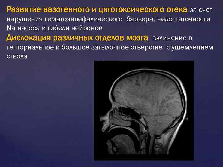 Развитие вазогенного и цитотоксического отека за счет нарушения гематоэнцефалического барьера, недостаточности Na насоса и