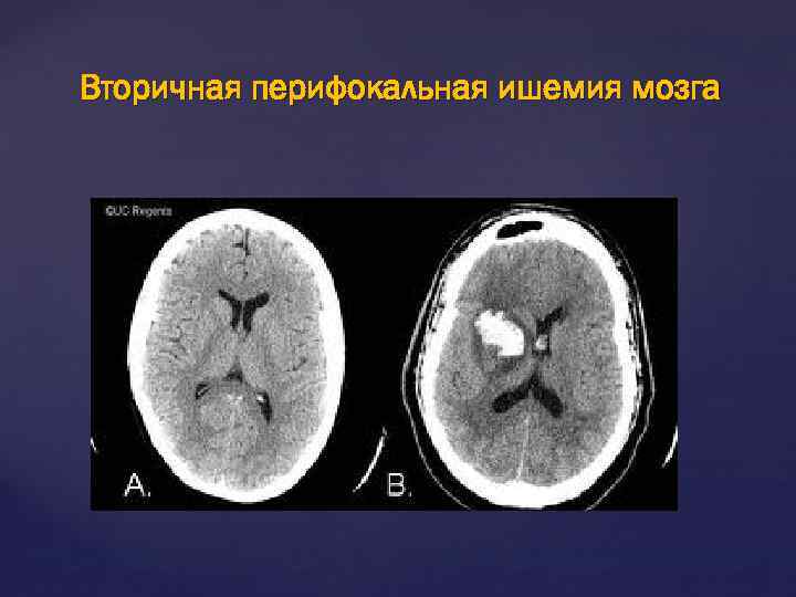 Вторичная перифокальная ишемия мозга 