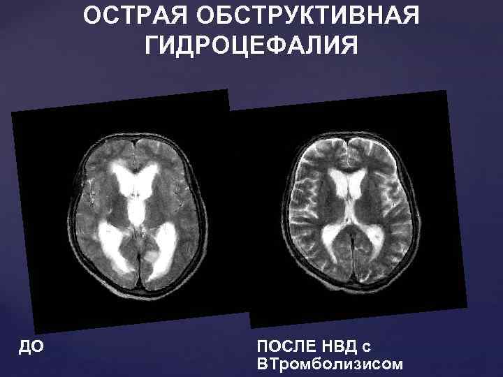 ОСТРАЯ ОБСТРУКТИВНАЯ ГИДРОЦЕФАЛИЯ ДО ПОСЛЕ НВД с ВТромболизисом 