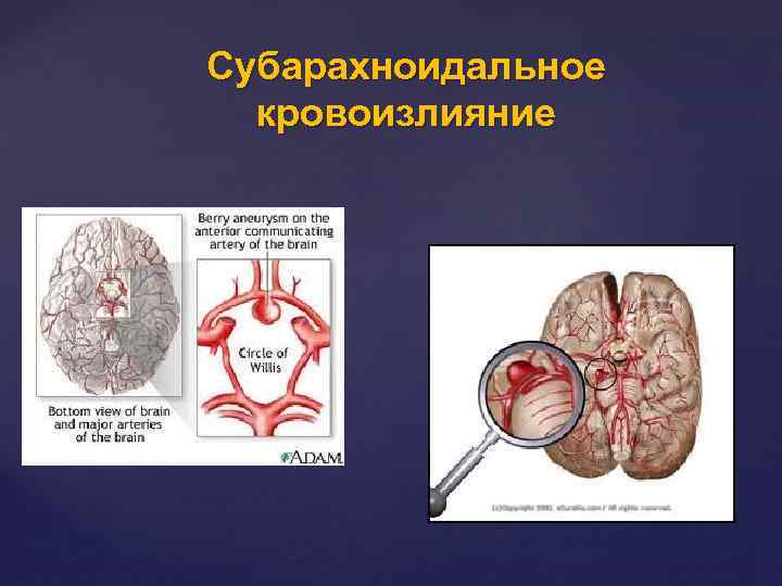 Субарахноидальное кровоизлияние 