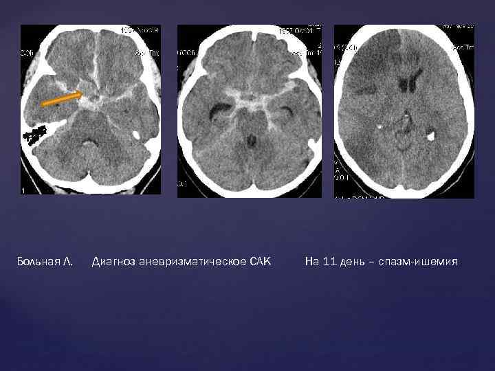 Больная Л. Диагноз аневризматическое САК На 11 день – спазм-ишемия 