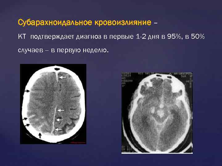 Субарахноидальное кровоизлияние – КТ подтверждает диагноз в первые 1 -2 дня в 95%, в