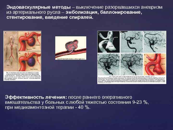 Эндоваскулярные методы – выключение разорвавшихся аневризм из артериального русла – эмболизация, баллонирование, стентирование, введение