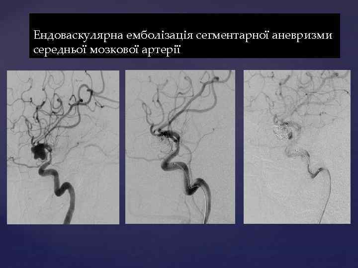 Ендоваскулярна емболізація сегментарної аневризми середньої мозкової артерії 