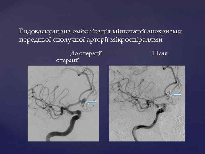 Ендоваскулярна емболізація мішочатої аневризми передньої сполучної артерії мікроспіралями До операції Після 