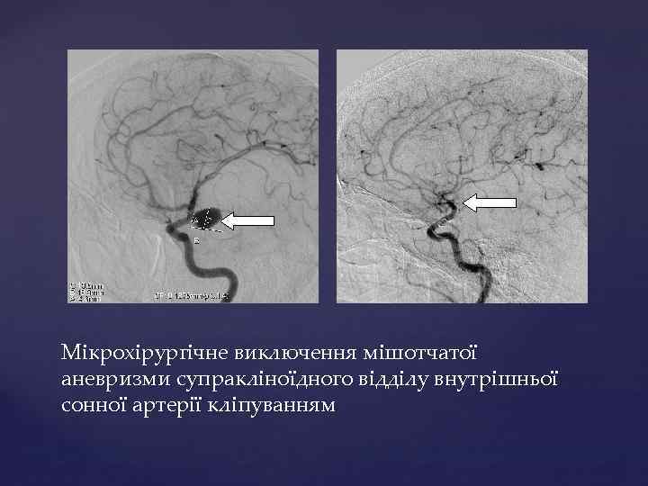 Мікрохірургічне виключення мішотчатої аневризми супракліноїдного відділу внутрішньої сонної артерії кліпуванням 