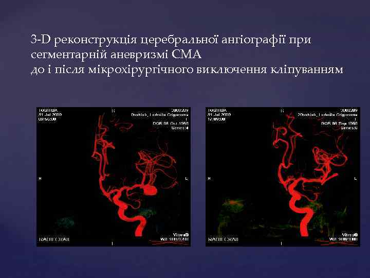 3 -D реконструкція церебральної ангіографії при сегментарній аневризмі СМА до і після мікрохірургічного виключення