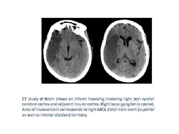 CT study of Brain shows an infarct involving right peri sylvian cerebral cortex and