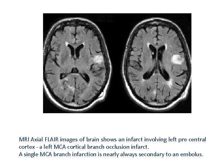 MRI Axial FLAIR images of brain shows an infarct involving left pre central cortex